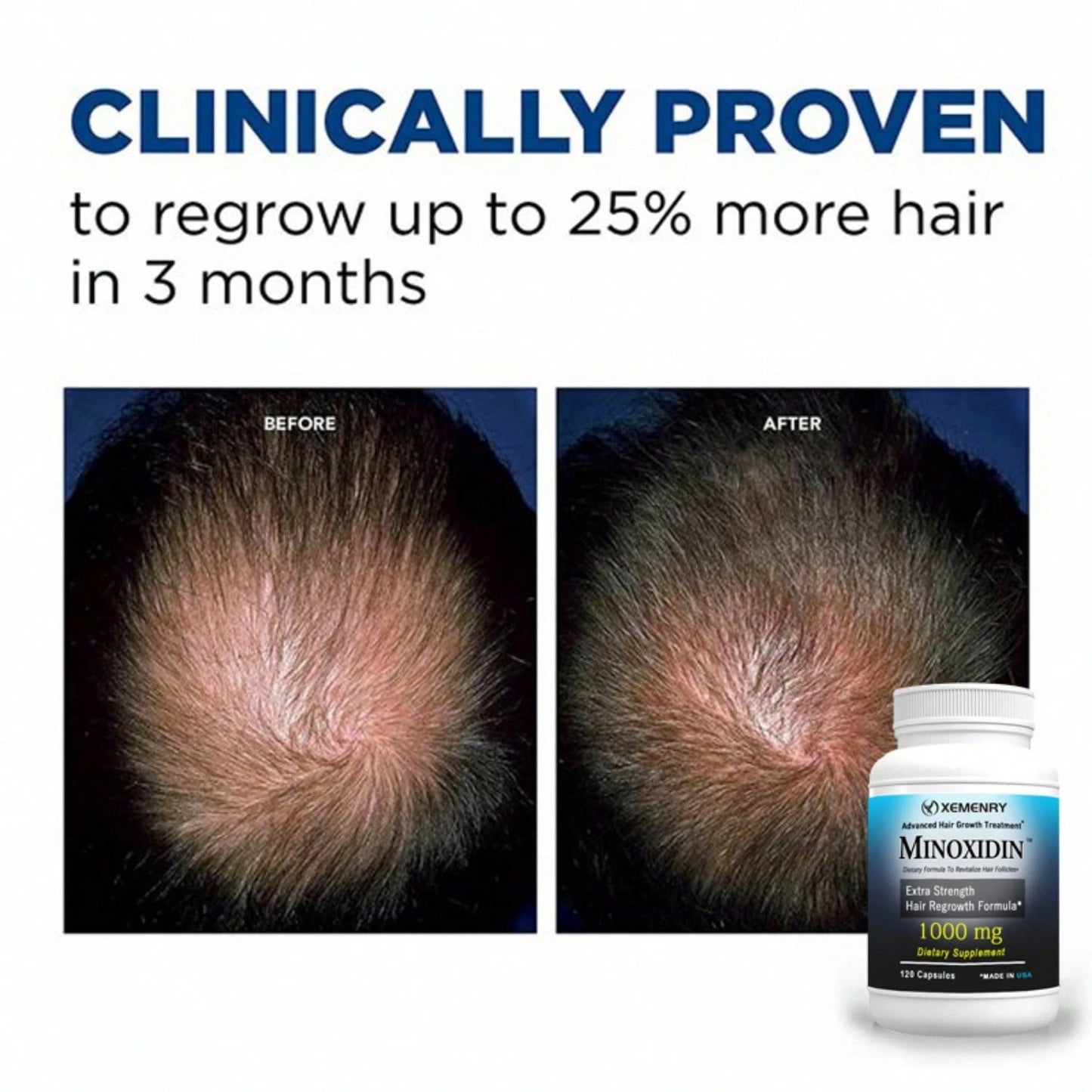 XEMENRY Minnoxidin- Extra Strength Hair Regrowth Formula,Prevent Hair Loss, Repair Hair, Help Promote Hair Follicle Activity- 120pcs