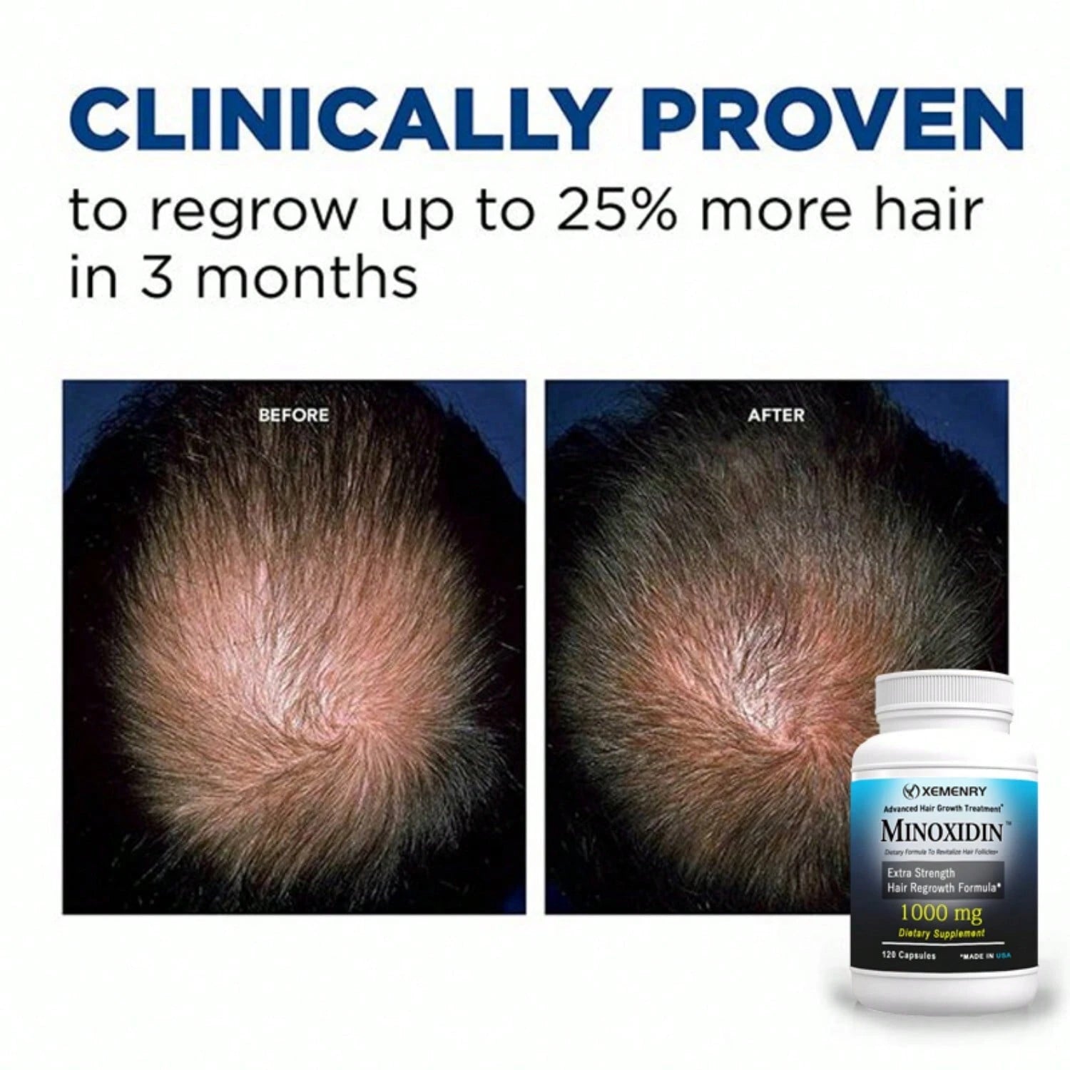 XEMENRY Minnoxidin- Extra Strength Hair Regrowth Formula,Prevent Hair Loss, Repair Hair, Help Promote Hair Follicle Activity- 120pcs