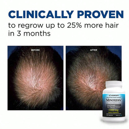 XEMENRY Minnoxidin- Extra Strength Hair Regrowth Formula,Prevent Hair Loss, Repair Hair, Help Promote Hair Follicle Activity- 120pcs